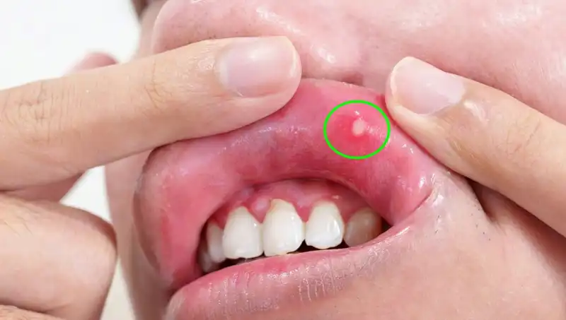 Vücudunuzda B vitamini Eksikliği Mi Var? İşte Belirtileri!