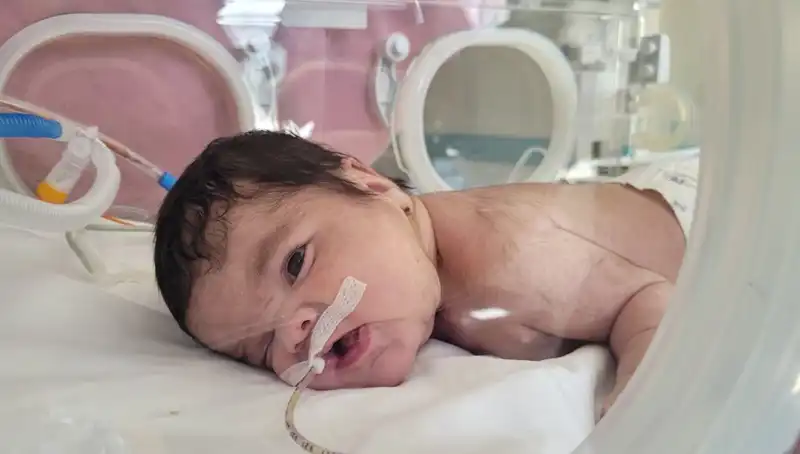 Dünyada 7. Kez Görülen Olay: 34 Haftalık Eymen Bebeğin Boynundan Çıkarıldı
