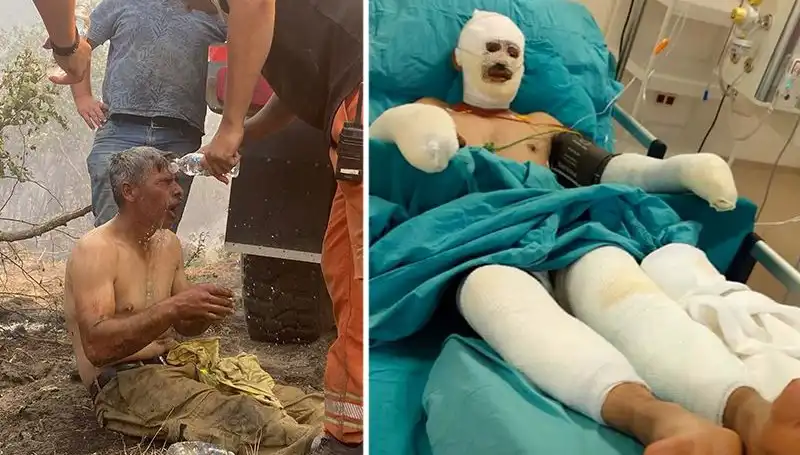 Yanıyorum Diye Feryat Eden Orman İşçisi Tedavi Sürecine Alındı